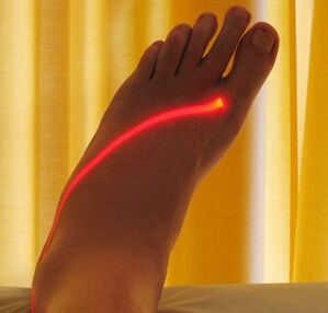 ласерски третман на проширени вени на нозете