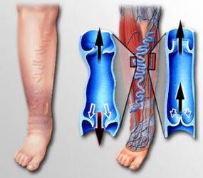 проток на крв во ногата со проширени вени