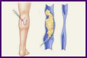 Склеротерапијата е популарен метод за ослободување од проширени вени на нозете