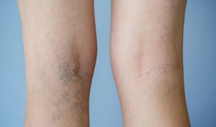 знаци на проширени вени на нозете кај жени